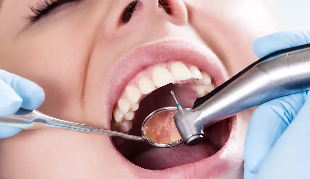 Composite Fillings