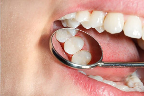 Composite Fillings